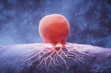 40% ca ung thư trên toàn cầu có thể phòng ngừa