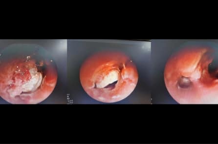 Hạt hạnh nhân mắc kẹt 7 ngày trong phế quản thiếu niên 15 tuổi 