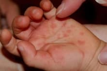 TP.HCM ghi nhận hơn 9.000 ca tay chân miệng, tăng gần 200%