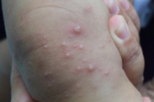 Bệnh tay chân miệng tăng báo động tại TP.HCM, đã có 3 ca tử vong