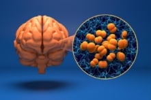 Cà Mau ghi nhận 3 ca nghi viêm não mô cầu, 1 người tử vong